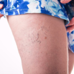 Два средства от варикоза Два средства от варикоза