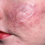 Демодекс на лице лечение народными средствами Демодекс на лице лечение народными средствами