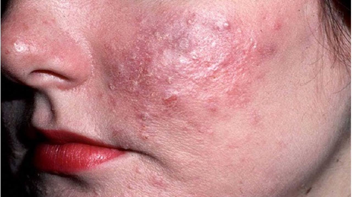 Демодекс на лице лечение народными средствами Демодекс на лице лечение народными средствами