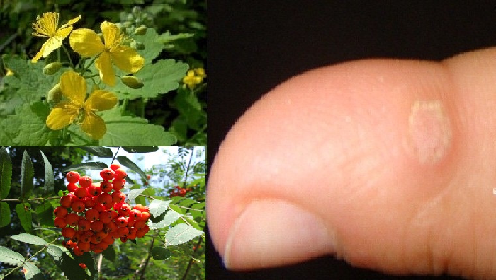 Лечение бородавок народными средствами Лечение бородавок народными средствами