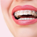 Брекеты: установка, виды, принцип действия