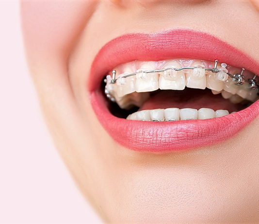 Брекеты: установка, виды, принцип действия