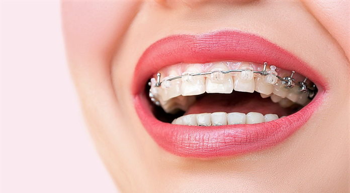 Брекеты: установка, виды, принцип действия