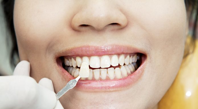 Коррекция зубных дефектов с помощью виниров