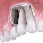 Этапы установки зубных имплантов и их особенности