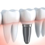 Протезирование зубов: методы и интересные факты