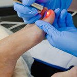 Эффективность лечения грибка ногтей лазером