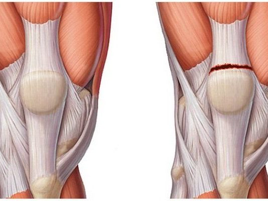 Эффективность лечебной физкультуры при повреждении связок коленного сустава