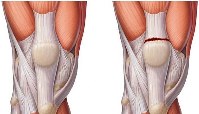 Эффективность лечебной физкультуры при повреждении связок коленного сустава