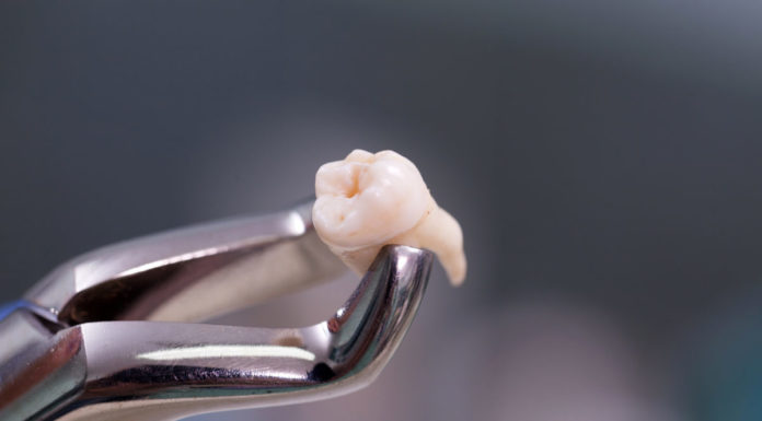 Как происходит удаление зуба?