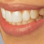 Виды металлокерамических коронок: их преимущества и недостатки