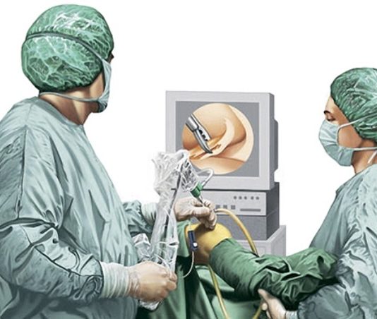 Показания к проведению артроскопии плечевого сустава