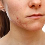 Акне у взрослых: причины