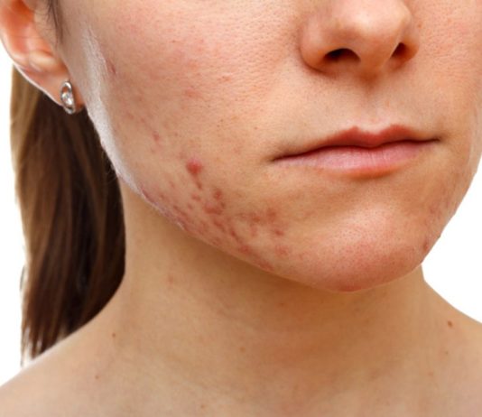 Акне у взрослых: причины