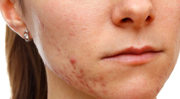 Акне у взрослых: причины
