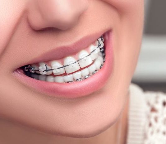 Этапы установки брекет систем