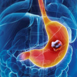 Рак желудка: описание заболевания