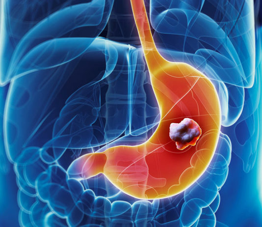 Рак желудка: описание заболевания