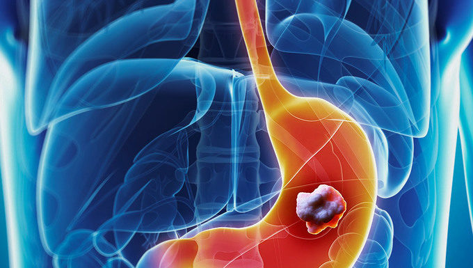 Рак желудка: описание заболевания