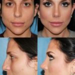 Виды современной ринопластики