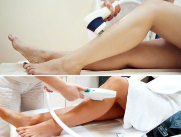 Эффективность и достоинства лазерной эпиляции