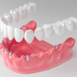 Имплантация All-on-6 – методика реставрации потерянных зубов