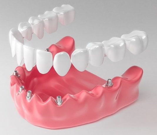 Имплантация All-on-6 – методика реставрации потерянных зубов