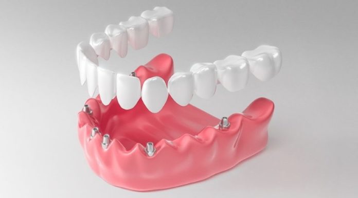 Имплантация All-on-6 – методика реставрации потерянных зубов