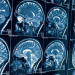 Зачем назначают МРТ головы и сосудов головного мозга?