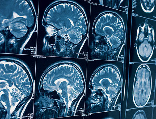Зачем назначают МРТ головы и сосудов головного мозга?