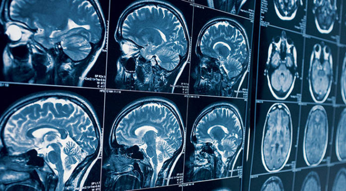 Зачем назначают МРТ головы и сосудов головного мозга?