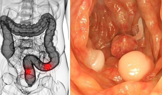 Рак толстой кишки: описание заболевания