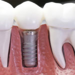 Имплантация зубов: какие импланты лучше ставить