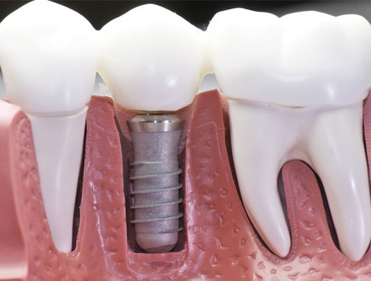 Имплантация зубов: какие импланты лучше ставить