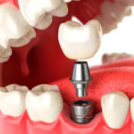 Имплантация зубов: кому на самом деле нужна?