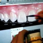 Цифровой дизайн улыбки: возможности, этапы