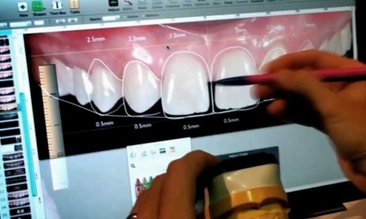 Цифровой дизайн улыбки: возможности, этапы