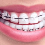 Брекеты Damon Clear: виды и преимущества