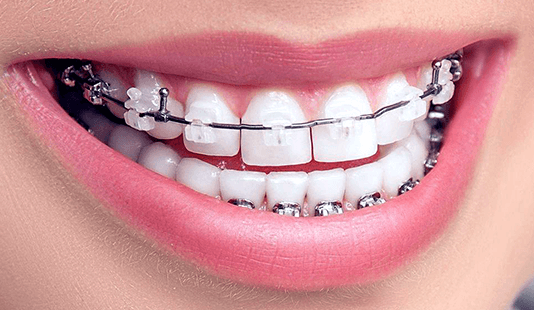 Брекеты Damon Clear: виды и преимущества