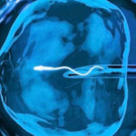 ЭКО — вспомогательная репродуктивная технология, применяемая при бесплодии