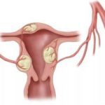 Миома матки при беременности: рекомендации гинеколога