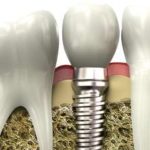 Что входит в имплантацию зубов под ключ?