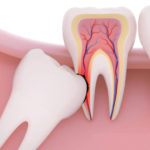 Удаление зуба мудрости: особенности и последствия