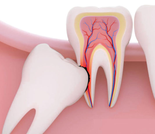Удаление зуба мудрости: особенности и последствия