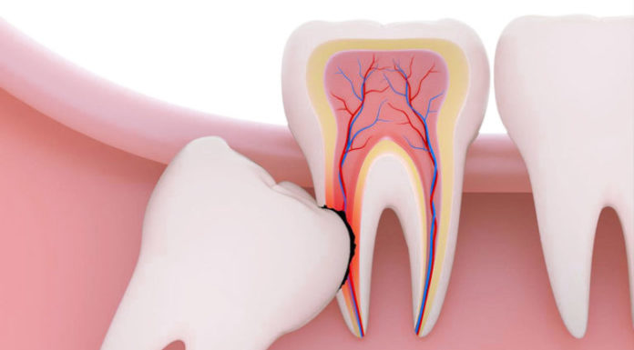 Удаление зуба мудрости: особенности и последствия