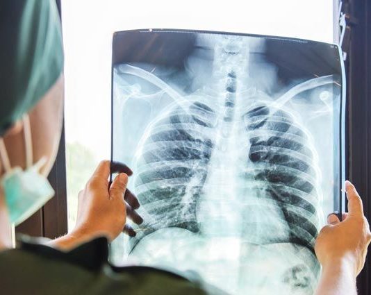 Как проходит восстановление после коронавируса?