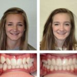 Какие бывают способы исправления прикуса?