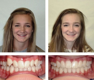 Какие бывают способы исправления прикуса?