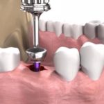 Зубной имплант: этапы протезирования