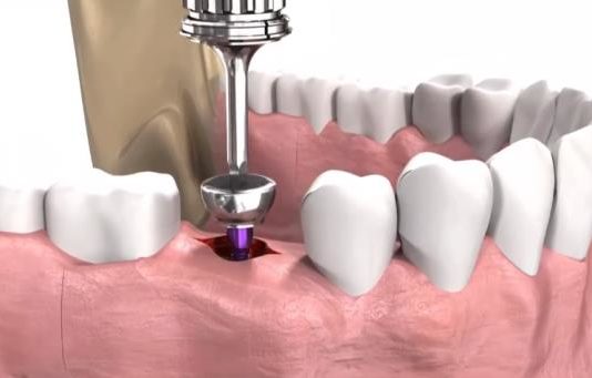 Зубной имплант: этапы протезирования